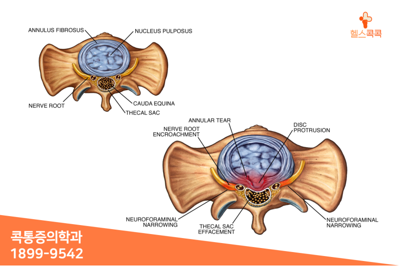 팔이저린이유 정확하게 파악하고 3
