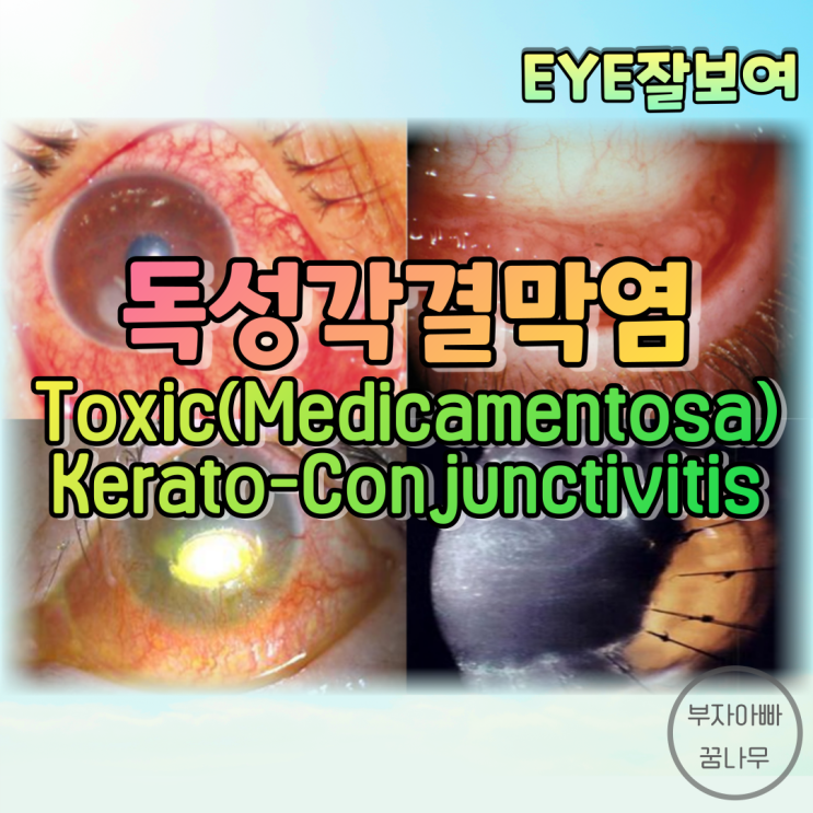 [EYE잘보여] 독성각결막염(Toxic Kerato-Conjunctivitis, Medicamentosa Kerato-Conjunctivitis) - 안약부작용, 점안액부작용