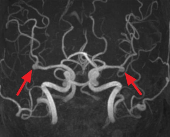 TFCA(Trans femoral cerebral angiography)란? TFCA 치료 및 간호