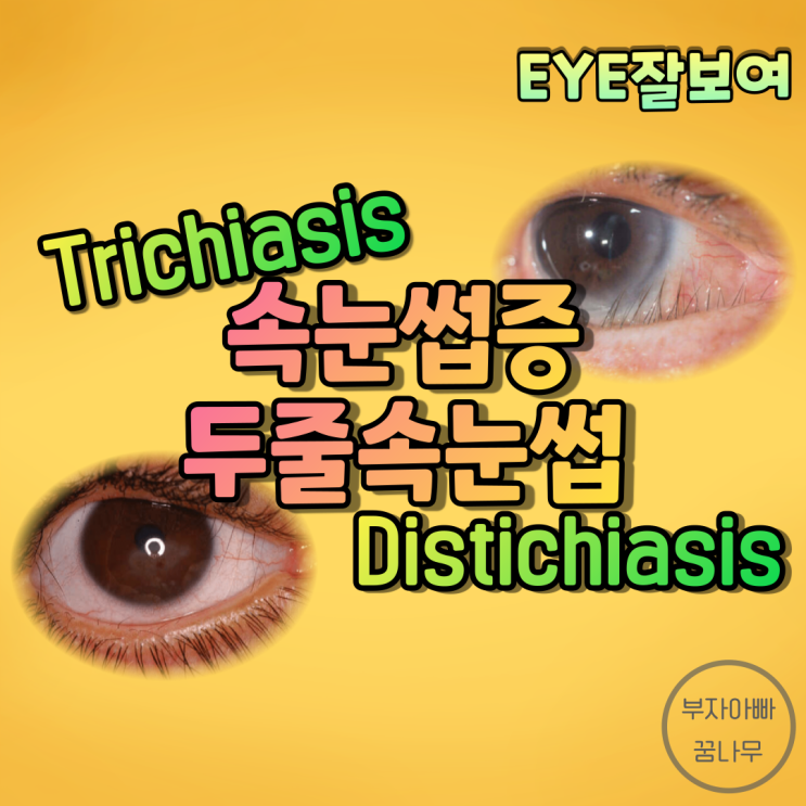 [EYE잘보여] 속눈썹증(Trichiasis, 첩모난생) vs. 두줄속눈썹(Distichiasis, 첩모중생) - 원인, 발병기전, 진단, 치료(시술 및 수술)