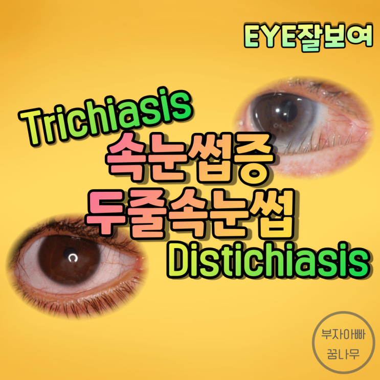  [EYE잘보여] 속눈썹증(Trichiasis, 첩모난생) vs. 두줄속눈썹(Distichiasis, 첩모중생) - 원인, 발병기전, 진단, 치료(시술 및 수술)