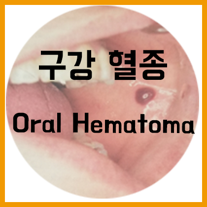  [목] 구강 혈종(Oral hematoma)