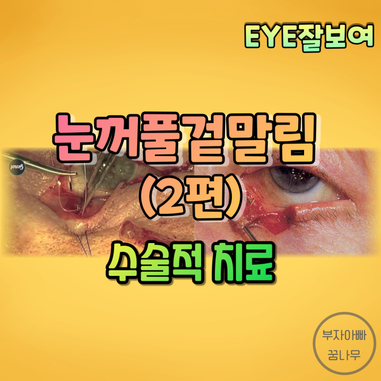  [EYE잘보여] 눈꺼풀겉말림(안검외반, Ectropion) (2) - 수술적 치료(반흔성겉말림, 퇴행성겉말림, 눈물점겉말림, 눈꺼풀판겉말림, 마비성겉말림)