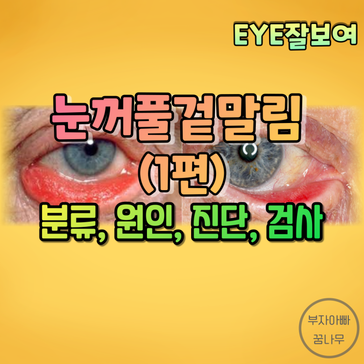 [EYE잘보여] 눈꺼풀겉말림(안검외반, Ectropion) (1) - 분류(반흔성, 퇴행성, 마비성, 선천성), 원인, 증상, 검사, 진단