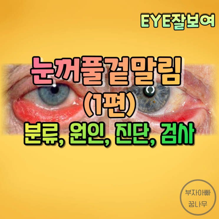 [EYE잘보여] 눈꺼풀겉말림(안검외반, Ectropion) (1) - 분류(반흔성, 퇴행성, 마비성, 선천성), 원인, 증상, 검사, 진단