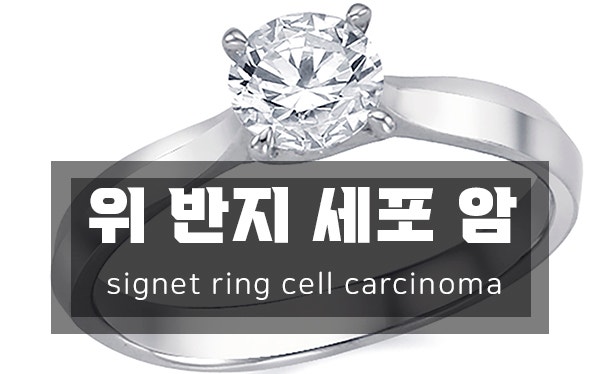 위내시경 - 반지세포암 (signet ring cell carcinoma)