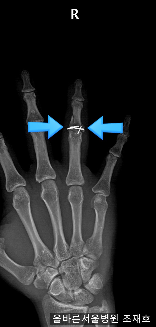 손가락 골절 후 발생한 관절염에서 3