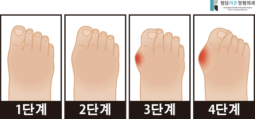  무지외반증 수술 후기? 족부 의사가 "직접" 보여드립니다.