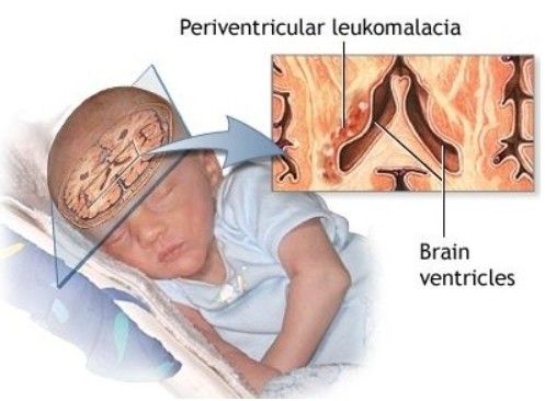 뇌성마비/정상발달 설명해주는 남자 - 백질연화증(PVL, periventricular leukomalacia)