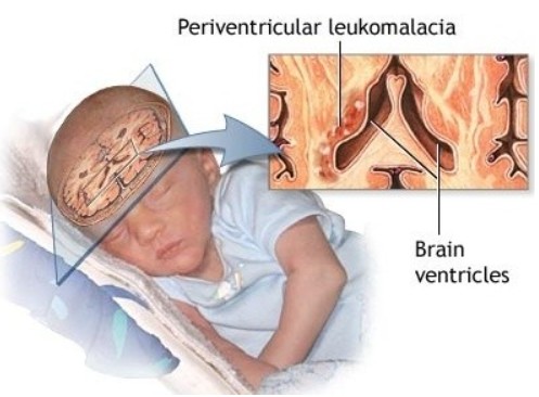  뇌성마비/정상발달 설명해주는 남자 - 백질연화증(PVL, periventricular leukomalacia)