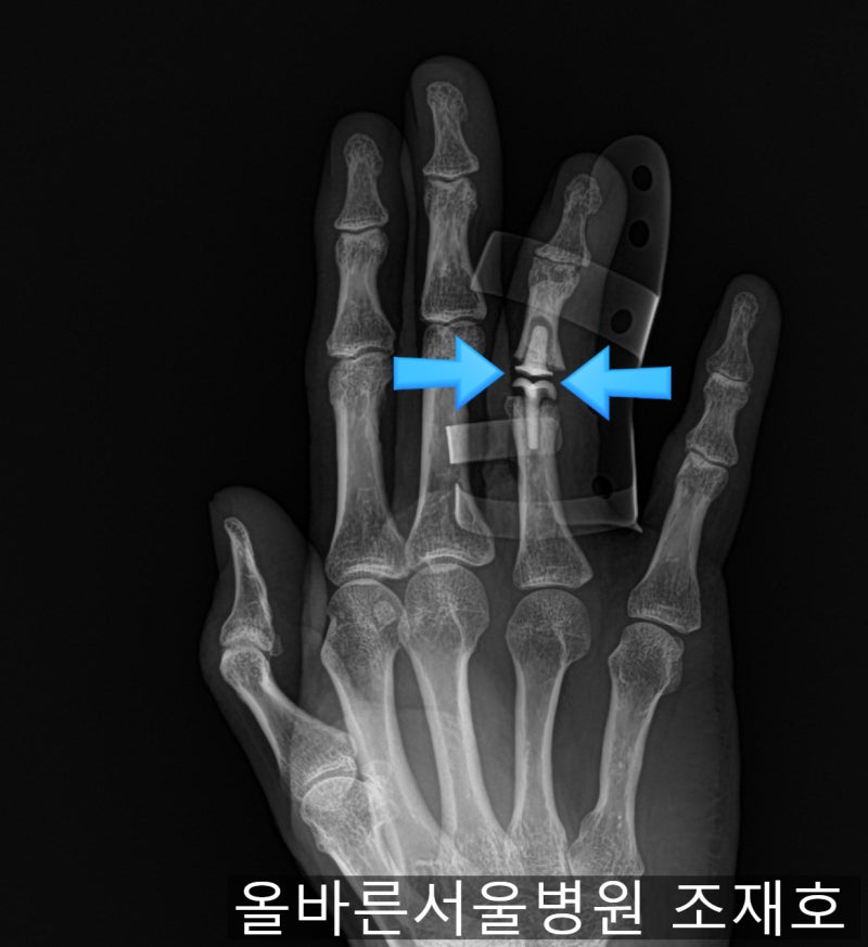 손가락 골절 후 발생한 관절염에서 4