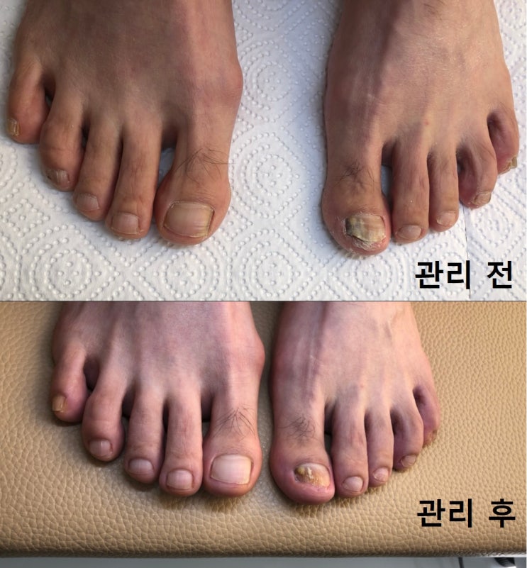  부산발톱무좀, 연산동발톱무좀 'NP케어 연산점' 발톱무좀 스케일링 후기