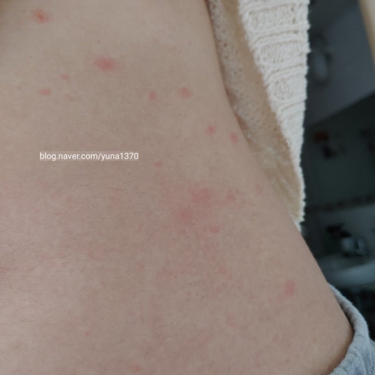  백신 두드러기 부작용 같은 장미색비강진 진단받고옴