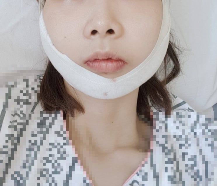  무턱 양악 수술 #10 철심제거 수술