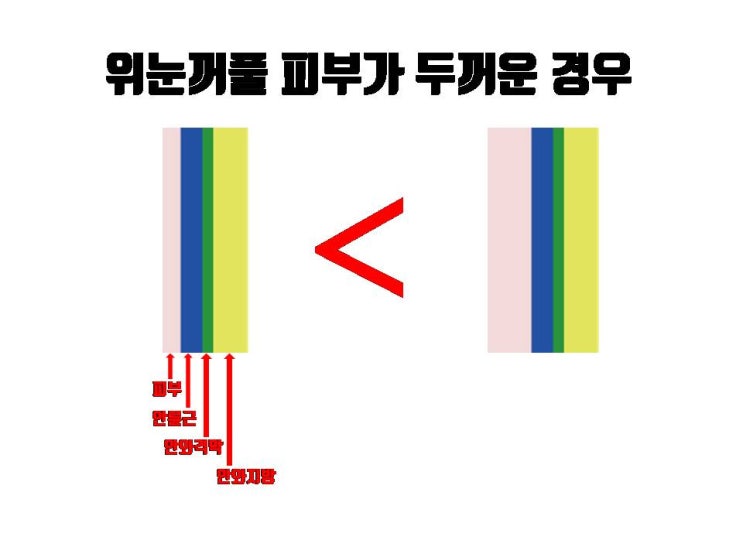  쌍꺼풀 수술 후 붓기 정성스러운 수술로 줄일 수 있어요!!!