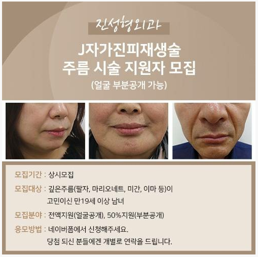 강남 유명 성형외과에서 무료 주름 시술 지원자 모집!  - 주름이 고민이신 분 어때요~? ^^