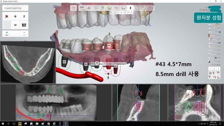  Navigation Dental Implant in Seoul, Korea.