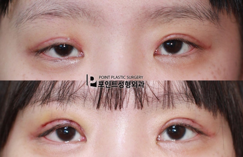 포인트성형외과 눈매교정 부작용 실패 조기재수술 수술전후사진 : 네이버 블로그 포인트성형외과 눈매교정 부작용 실패 조기재수술 수술전후사진 : 네이버 블로그