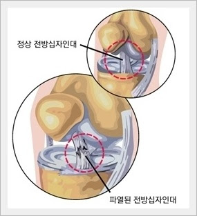  전방십자인대파열손상 원인증상 통증부위 인대재건술이식 진단수술치료 재활운동 회복예후기간 간호진단과정