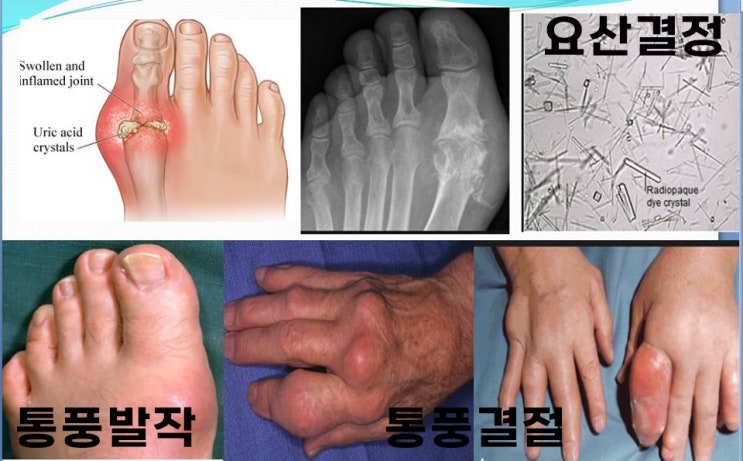  통풍약 복용으로 통풍 치료 통풍 합병증 예방