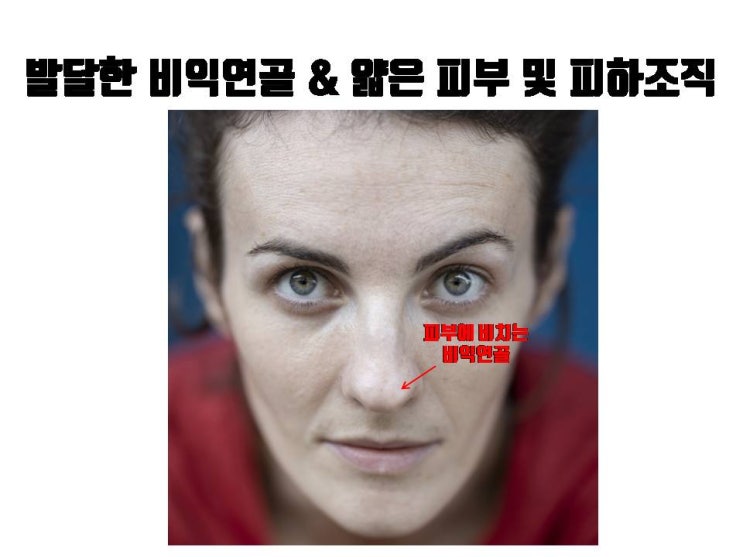  코끝 갈라짐 (엉덩이코), 코끝 연골 묶기 만으로도 교정할 수 있어요!