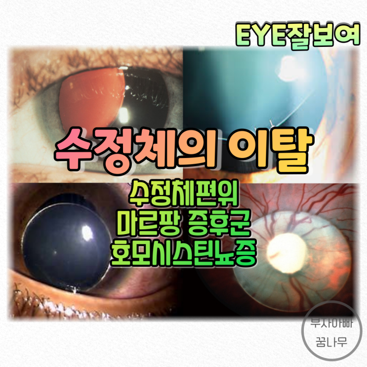 [EYE잘보여] 수정체이탈(Lens Luxation, Dislocation), 수정체부분이탈(Lens Subluxation) - 마르팡 증후군, 호모시스틴뇨증