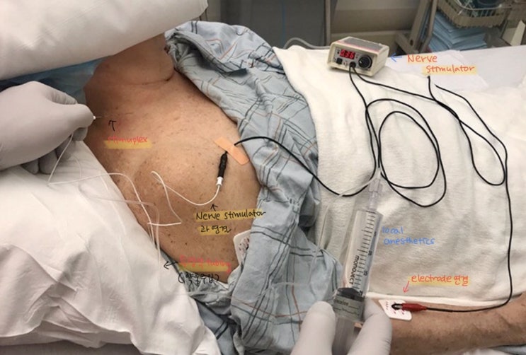  nerve stimulator 이란 무엇인가?- 말초신경 차단술(peripheral nerve block)(3)