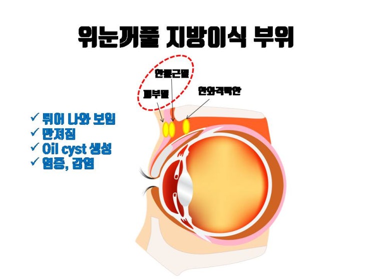  꺼진 눈 개선을 위해 지방이식 후 지방이 비춰 보일 때 절개 쌍꺼풀로 개선 가능해요!!!