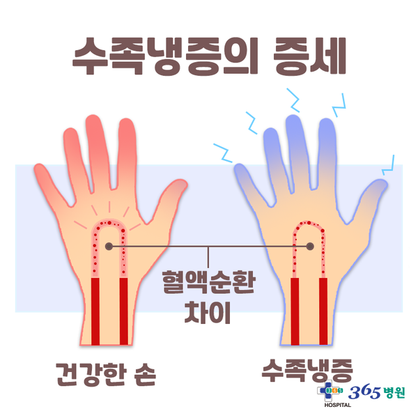  [창원마산 척추관절 디스크 365병원] 수족냉증