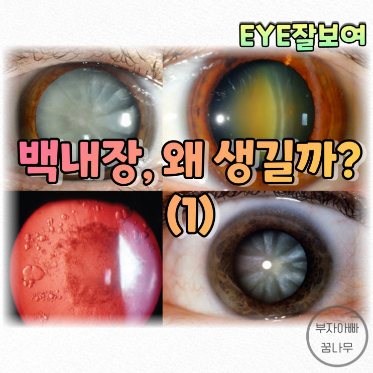  [EYE잘보여] 백내장은 왜생길까? (1) - 정상적인 신체반응에 의해 생기는 백내장(노화, 단밸질 변화, 삼투압차, 산화스트레스, 막 변화와 이온유입)