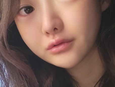 압구정피부과 / 얼굴형에 맞춰 진행하는 인모드맛집의 파워 인모드 후기