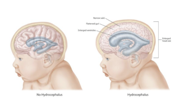  뇌성마비/정상발달 설명해주는 남자 - 뇌실내출혈(IVH, intraventicular hemorrhage)