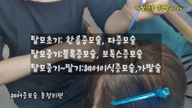  탈모세요? 숱보강 해도 그만! 안해도 그만으로 하실건가요? 헤어증모술/보톡스증모술/춘천가발전문점