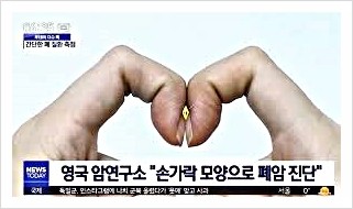  폐암 증상 진행 진단 치료 재발 전이