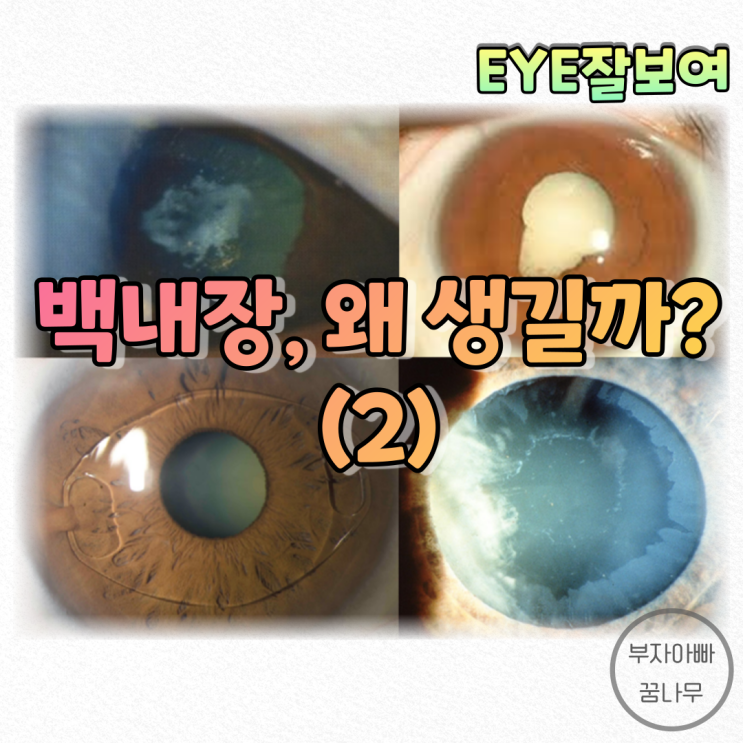 [EYE잘보여] 백내장은 왜 생길까? (2) - 유리체절제술 후, 유수정체 인공수정체(안내렌즈삽입술) 후, 녹내장 및 포도막염과 연관된 백내장