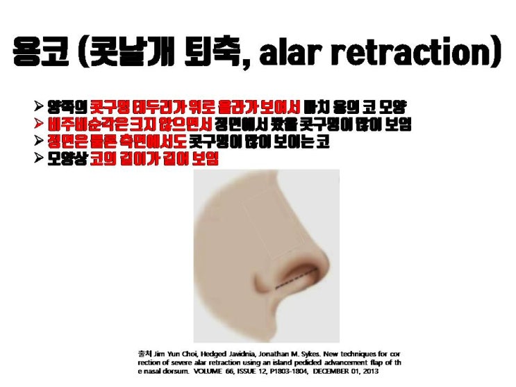  용코(콧날개퇴축)로 고민인 분들!! 코수술로 용코 교정 가능하답니다.