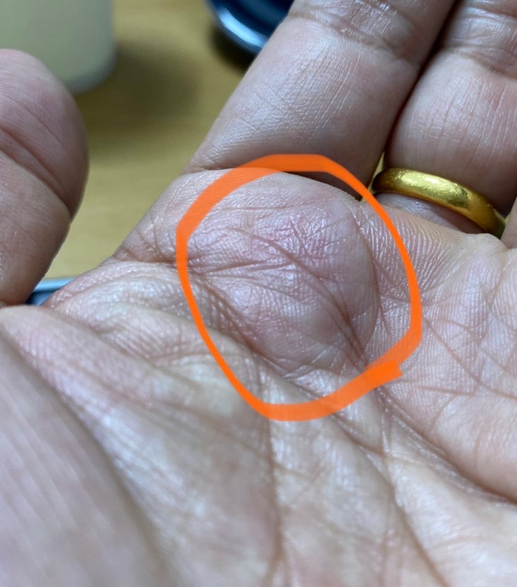 방아쇠수지 증후군 때문에 손가락 치료 받았어요. 방아쇠수지 증후군 때문에 손가락 치료 받았어요.
