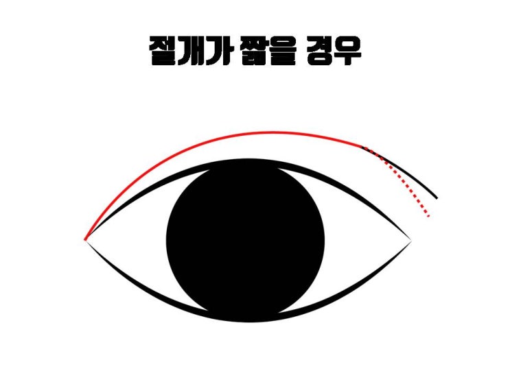  쌍꺼풀 바깥쪽 부분에 겹주름이 생기는 경우 절개 쌍꺼풀 재수술로 교정할 수 있어요!!!