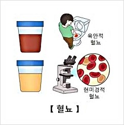  방광암 증상 진단 종류 재발 주기적인 추적 검사