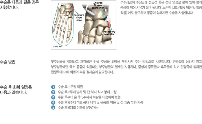 부주상골 증후군 증상 및 깔창 및 2