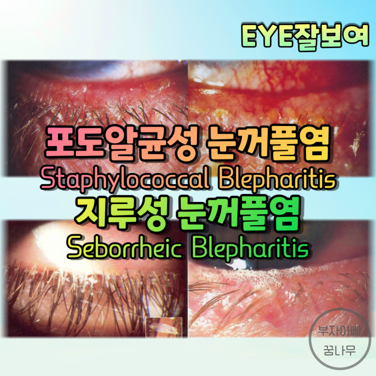 [EYE잘보여] 눈꺼풀염(안검염, Blepharitis) (1) - 감염성 포도알균성(Staphylococcal) 눈꺼풀염, 지루성(Seborrheic) 눈꺼풀염: 증상, 치료