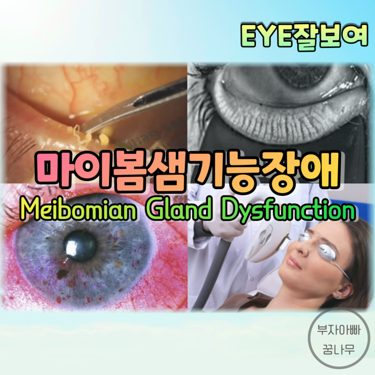 [EYE잘보여] 눈꺼풀염(Blepharitis) (2) - 마이봄샘기능장애(마이봄선기능장애, Meibomian Gland Dysfunction;MGD): 원인, 증상, 진단, 치료
