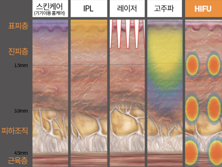  집속초음파, 리프팅의 원리가 뭐야?