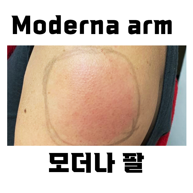  모더나 팔통증, 팔붓기, 열감의 부작용 알아보기 (모더나암)