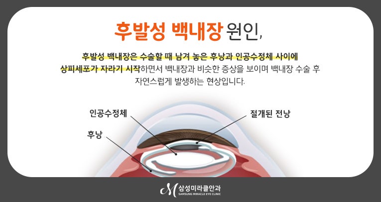 후발성 백내장은 어떤 원인으로 발생하는 것일까요?