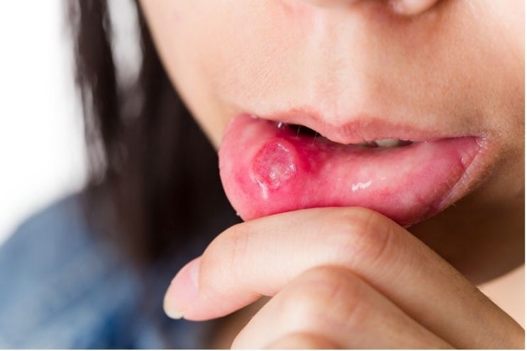  헤르페스 구내염 (Herpetic Stomatitis) 빨리낫는법