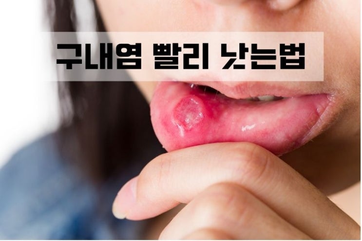  Stomatitis 입안이 헐었을때 영양제(아프타성 구내염)