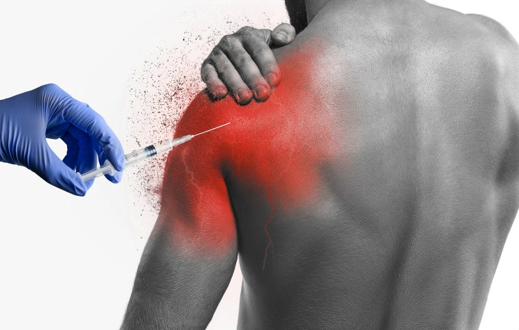  어깨 스테로이드 주사? 필수 아닙니다.