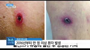  쯔쯔가무시병 원인증상특징 진드기바이러스감염병 항생제치료 예후경과 피부발진 간호중재진단