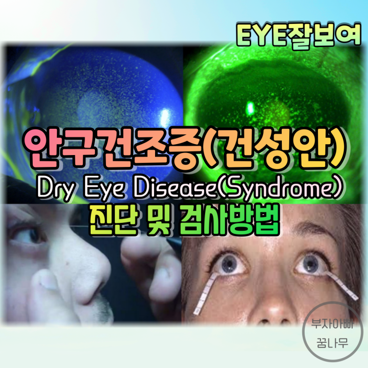 [EYE잘보여] 안구건조증, 건성안(Dry Eye Disease, Dry Eye Syndrome) (2) - 진단 및 검사방법